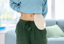 Жизнь после хирургического лечения язвенного колита: диета, прогноз и многое другое