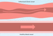 АНКС-ассоциированный васкулит: понимание симптомов, диагностики и долгосрочного лечения