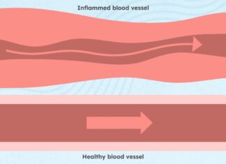 Vascularite associée aux ANCA : comprendre les symptômes, le diagnostic et la prise en charge à long terme