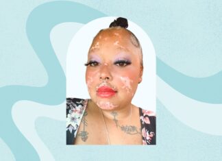 Життя з вовчаком і ревматоїдним артритом: стійкість, самозахист та довгий шлях до здоров’я