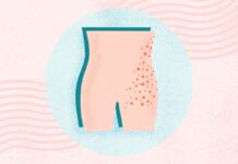 Оперезуючий лишай: розуміння хворобливої реактивації вірусу