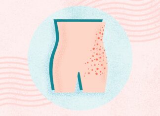 Herpes zoster: comprendere la dolorosa riattivazione virale